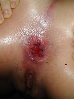 Gay Anal Gape Pics